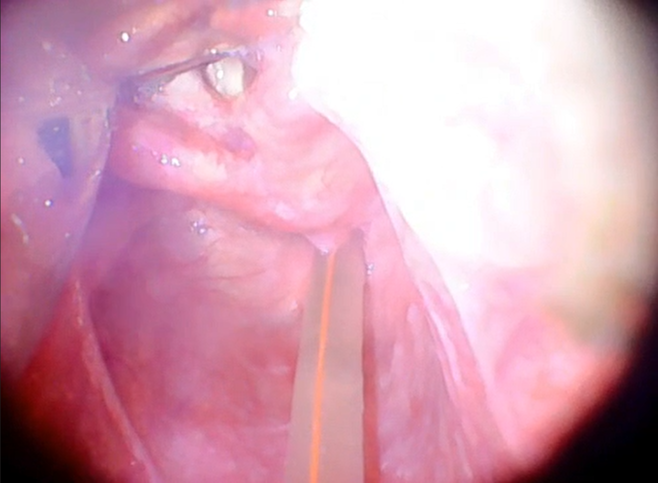 Load video: Real Intubation at KD Hospital