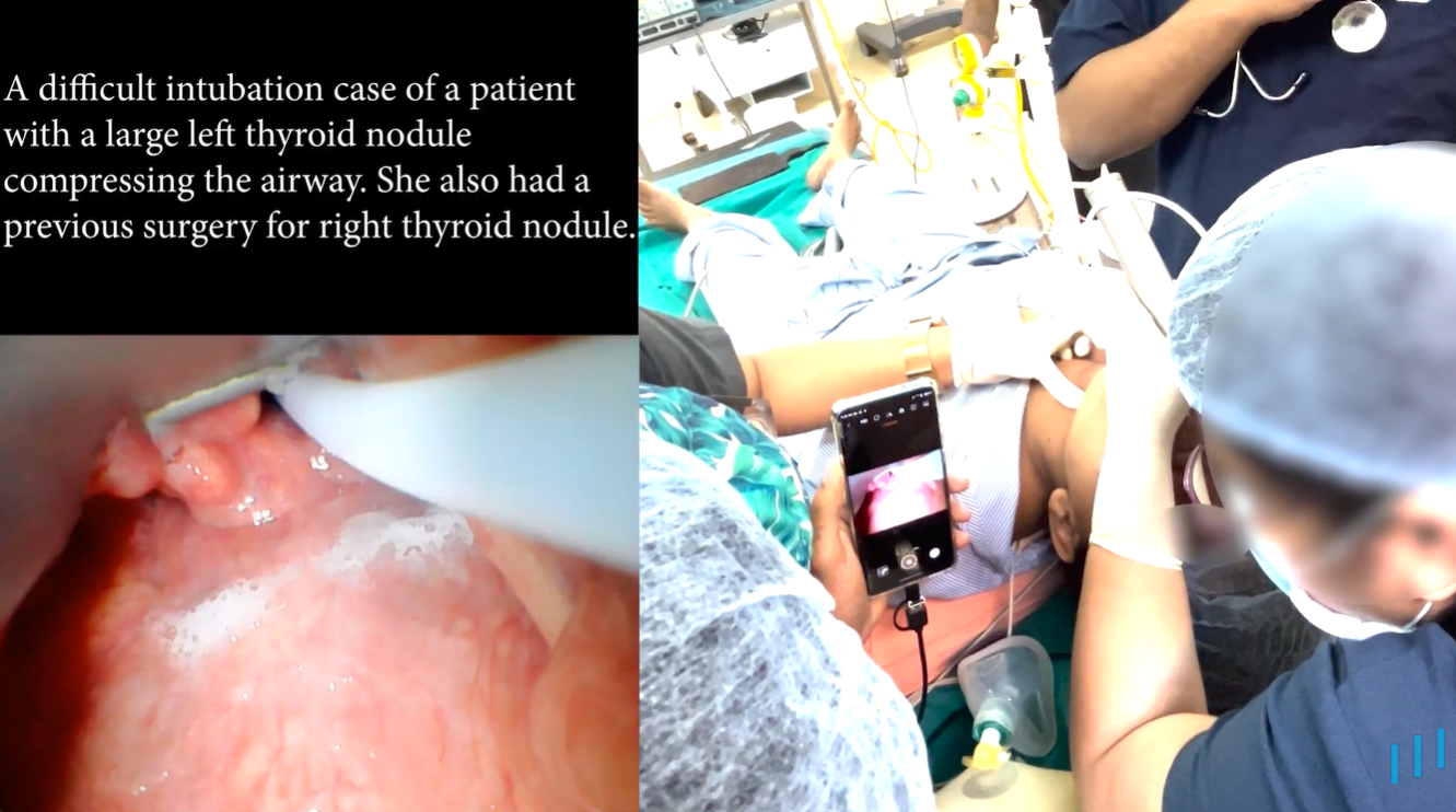Load video: Real Intubation with UVEAL at Civil Hospital, Gandhinagar