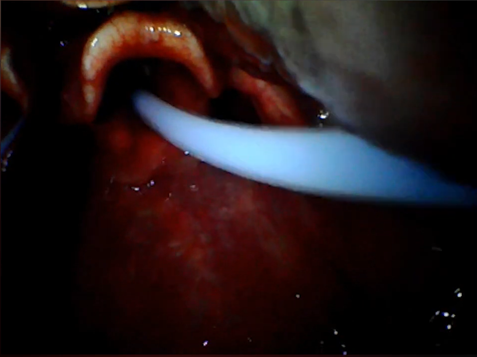 Load video: Real Intubation with UVEAL in Aurangabad, Maharashtra
