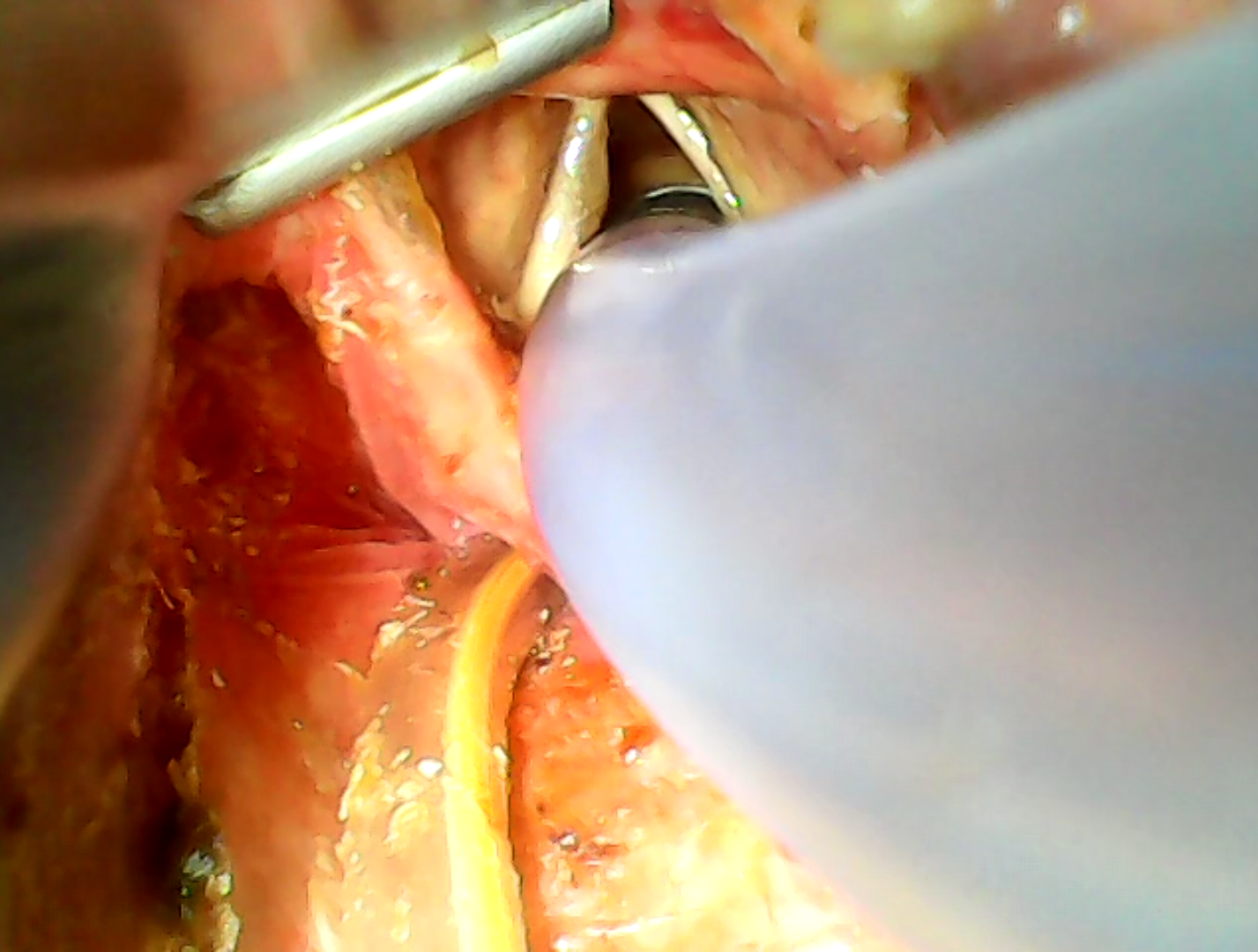 Load video: Real Intubation at AIIMS Jodhpur